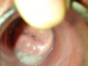 Cervix