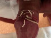 Toenails under the foreskin