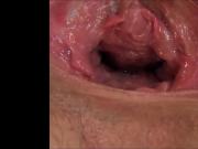 Gaping vagina