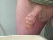 17 ball bearings and table tennis ball in foreskin with piss