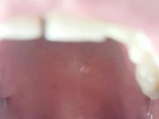 long uvula