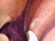 Speculums and Female Urethral Sounding